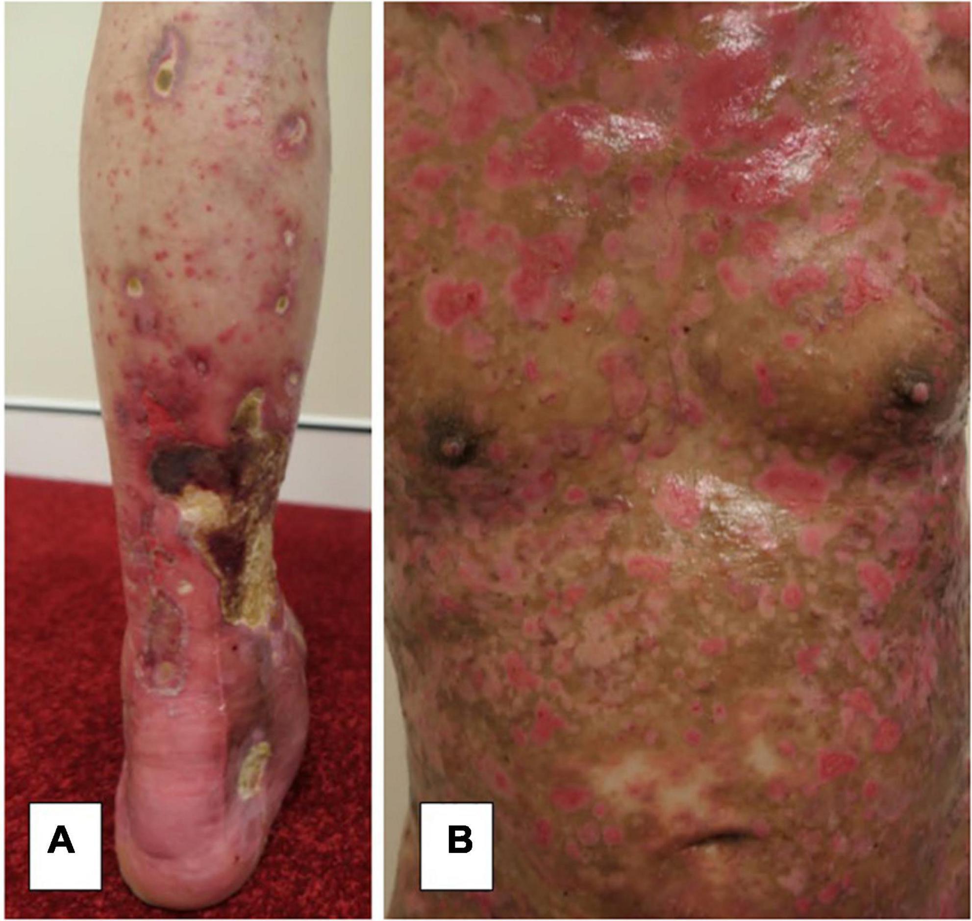 Autoimmune blistering skin diseases triggered by COVID-19 vaccinations: An Australian case series